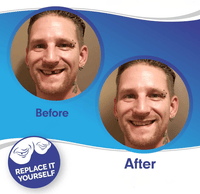 Allure Smile Veneer (Upper & Lower Included)