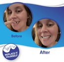 Allure Smile Veneer (Upper & Lower Included)