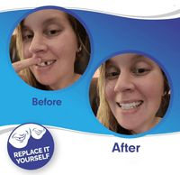 Allure Smile Veneer (Upper & Lower Included)